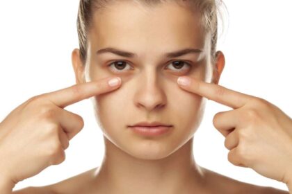 Do ponto de vista médico, fala-se em três grandes grupos de olheiras: pigmentares, vasculares e estruturais – depositphotos.com / VGeorgiev