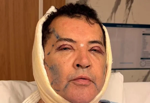 Beto Barbosa com faixa branca envolvendo a cabeça, inchaço e marcas de pontos próximos às pálpebras após cirurgia plástica.